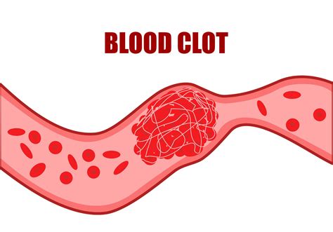 clot siti